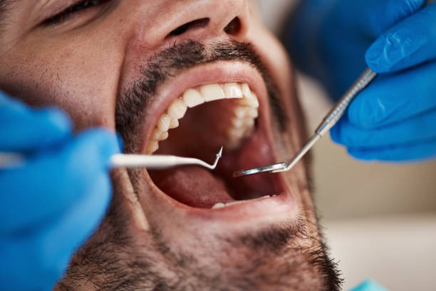Best Broken or Chipped Tooth Repair in Catawba, SC